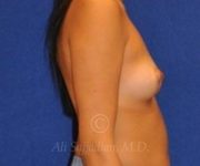 before breast augmentation right side view cast 8783