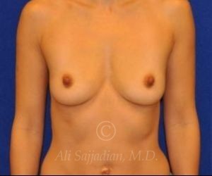 before breast augmentation front view case 8804