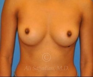 before breast augmentation front view case 8810