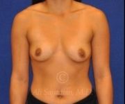 before breast augmentation front view case 8822