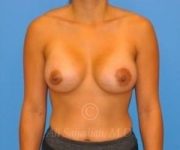 after breast augmentation front view case 8822