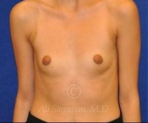 before breast augmentation front view case 8832