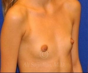 before breast augmentation right angle view case 8832