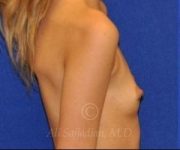 before breast augmentation right side view cast 8832