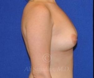 before breast augmentation right side view cast 8840