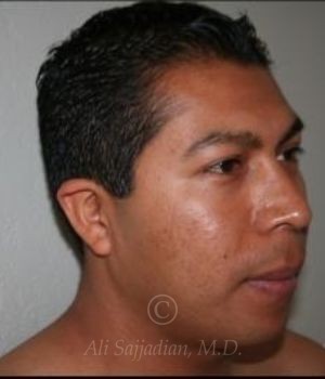 before otoplasty diagonal view