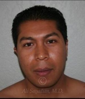 before otoplasty front view