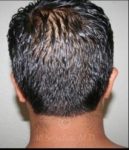 before otoplasty back view