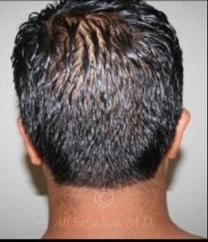 before otoplasty back view