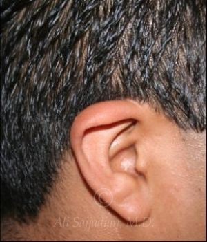 before otoplasty side view