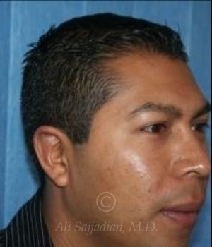 after otoplasty diagonal view