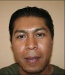 after otoplasty front view