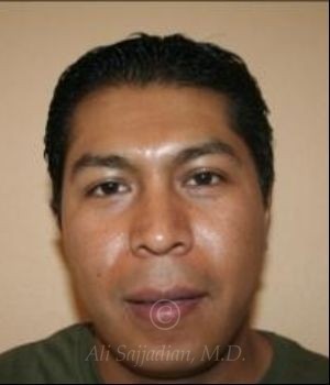 after otoplasty front view