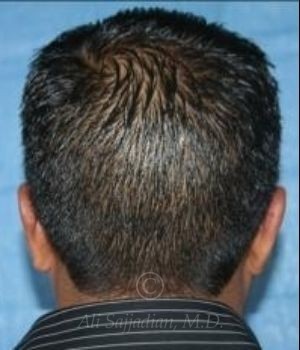 after otoplasty back view