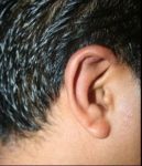 after otoplasty side view