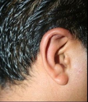 after otoplasty side view