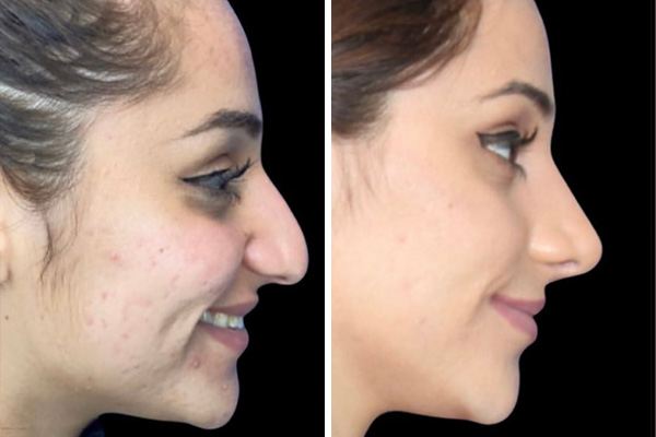 before and after results ethnic rhinoplasty right side female patient black background