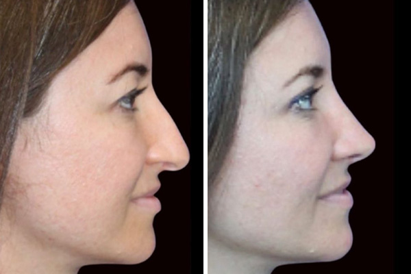 before and after side view preservation rhinoplasty female patient