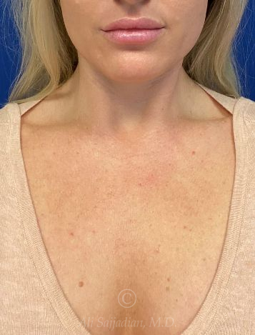 before IPL Treatment neck view case 12979