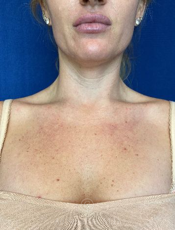 before IPL Treatment neck view case 12979