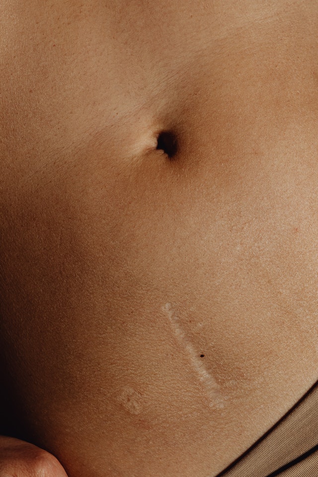 Variety of Tummy Tuck Scars