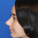 after rhinoplasty side view female patient case 12794