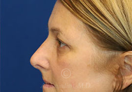 after eyelid surgery left side view female patient case 18333