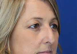 before eyelid surgery right view female patient case 18333