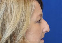 before eyelid surgery right side view female patient case 18333