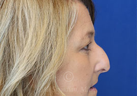 before eyelid surgery right side view female patient case 18333