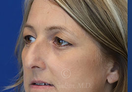 before eyelid surgery left view female patient case 18333