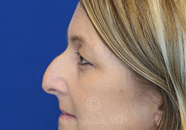 before eyelid surgery left side view female patient case 18333