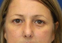 after eyelid surgery front view female patient case 18333