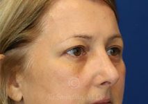 after eyelid surgery right view female patient case 18333