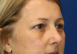 after eyelid surgery right view female patient case 18333