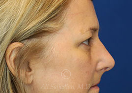 after eyelid surgery right side view female patient case 18333