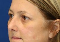 after eyelid surgery left view female patient case 18333