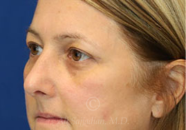after eyelid surgery left view female patient case 18333