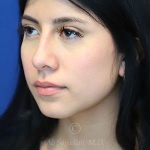 after non-surgical rhinoplasty left view female patient case 18322