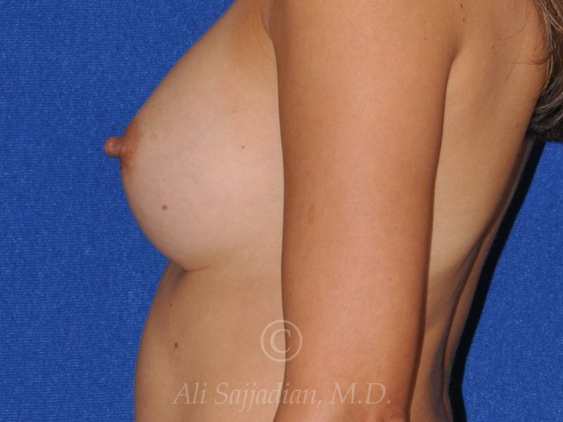 before revision breast augmentation left side view female patient case 18344