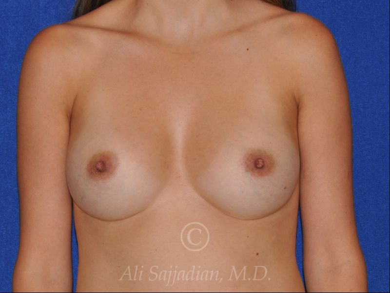 before revision breast augmentation front view female patient case 18344