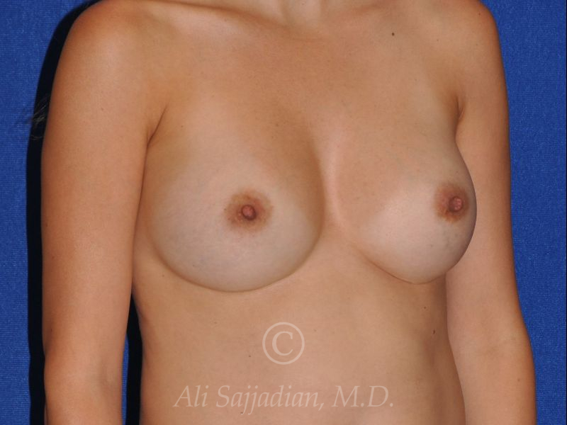 before revision breast augmentation right view female patient case 18344