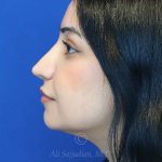 after rhinoplasty left side view female patient case 18286