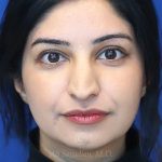 before rhinoplasty front view female patient case 18286