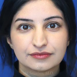 before rhinoplasty front view female patient case 18286