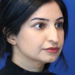 before rhinoplasty right view female patient case 18286