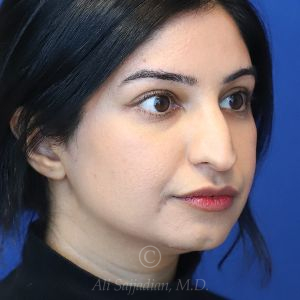 before rhinoplasty right view female patient case 18286