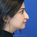 before rhinoplasty right side view female patient case 18286