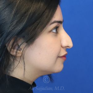 before rhinoplasty right side view female patient case 18286