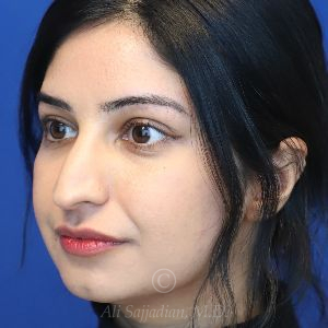 before rhinoplasty left view female patient case 18286